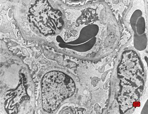 F,49y. | normal kidney